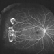 Sickle Cell Retinopathy Sickle Cell Retinopathy